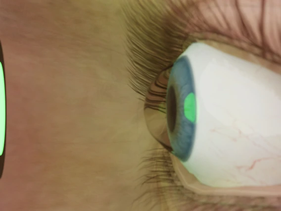 treatment of keratoconus