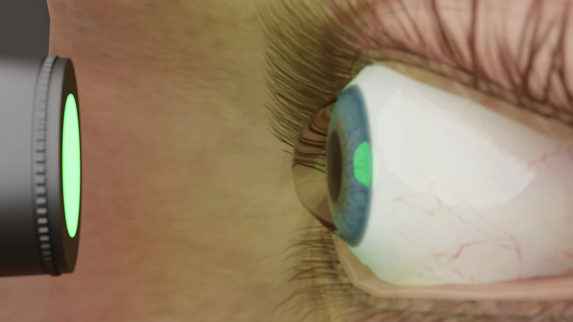 treatment of keratoconus